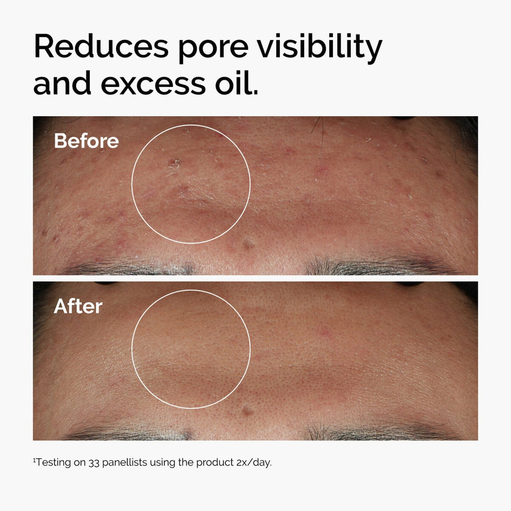 niacinamide-10-zinc-1-g1 ord-niacinamide-zinc-blemish-serum-before-after-pores.jpg