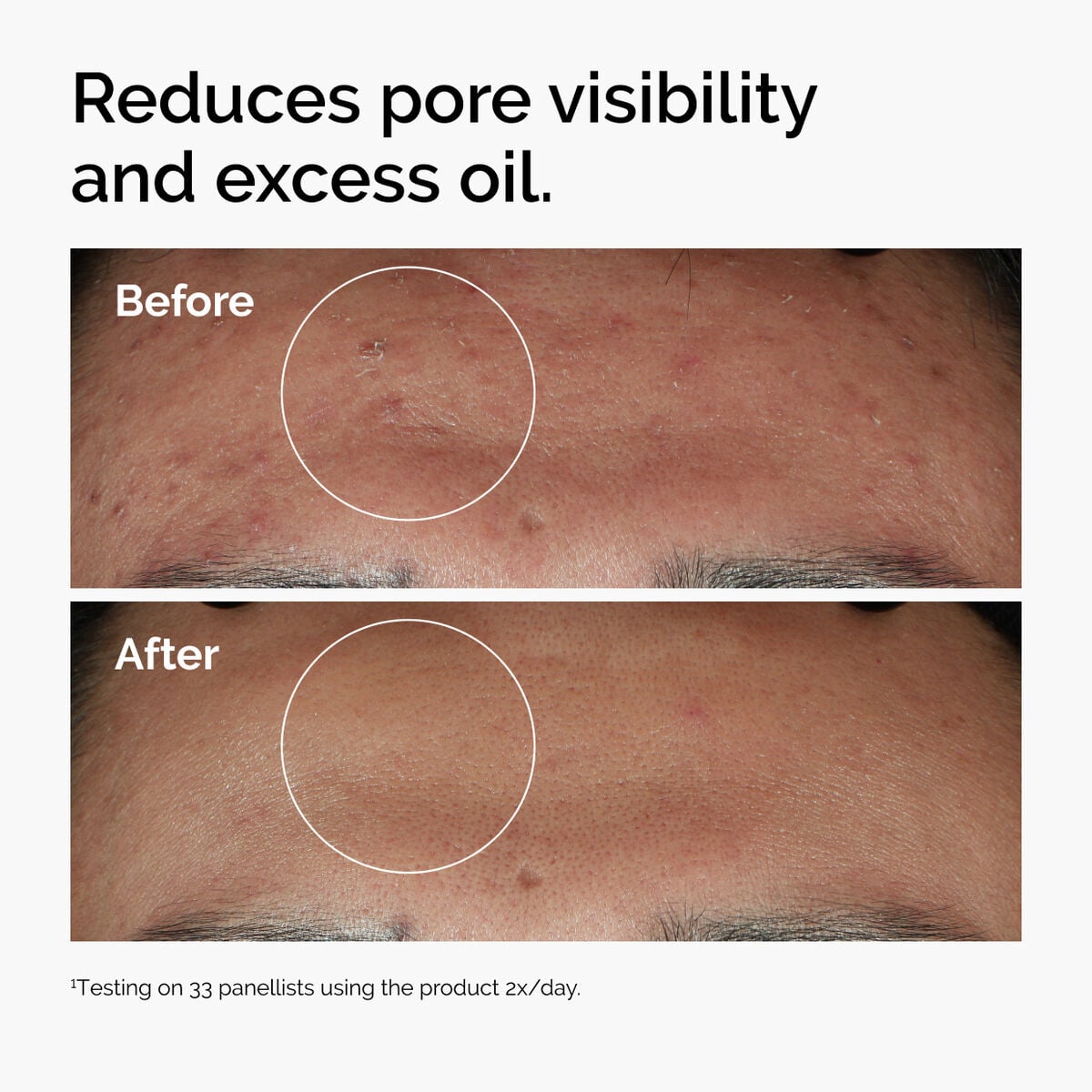 niacinamide-10-zinc-1-g1 ord-niacinamide-zinc-blemish-serum-before-after-pores.jpg