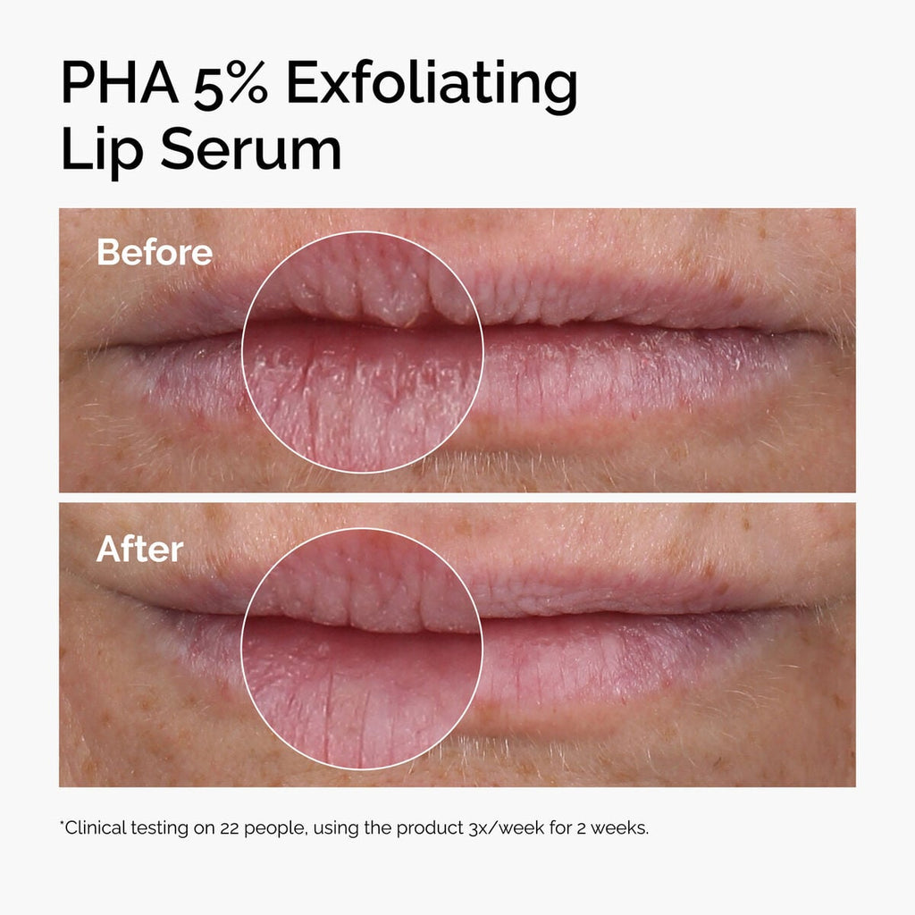 pha-5-exfoliating-lip-serum-y0 ord-pha-5pct-lip-exfoliating-serum-before-after.jpg