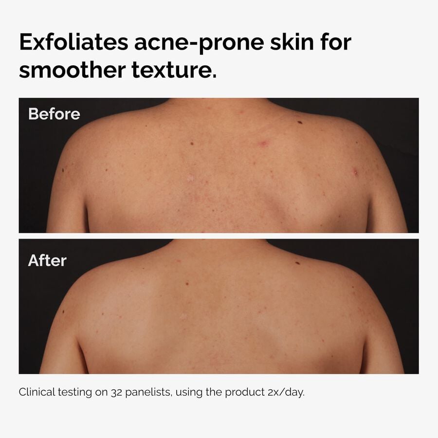 the-body-care-collection-a4 ord-salicylic-acid-body-serum-before-after-graphic-NA.jpg