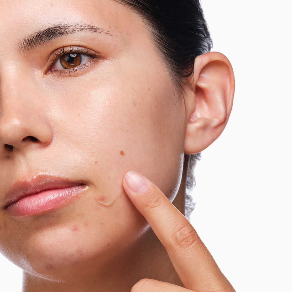 the-acne-set-m9 rdn-the-acne-set-application.png